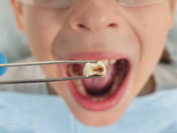 Best Emergency Tooth Extraction in Leetsdale, PA